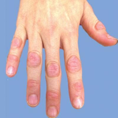 Acrokeratoelastoidosis and Knuckle Pads Coexisting in a Child | MDedge Dermatology