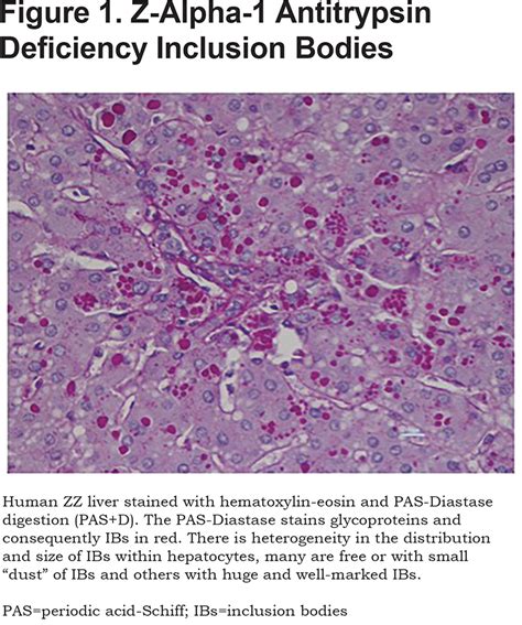 Alpha-1 Antitrypsin Deficiency and Liver Disease | Journal of The COPD Foundation