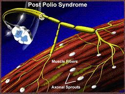 What is Post-Polio Syndrome? - Post Polio