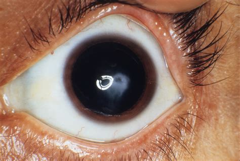 Keratoconus 1 | Hereditary Ocular Diseases