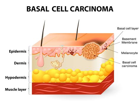 Basal Cell Carcinoma