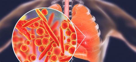 Mycoplasma +Natural Ways to Treat Mycoplasma Symptoms - Dr. Axe