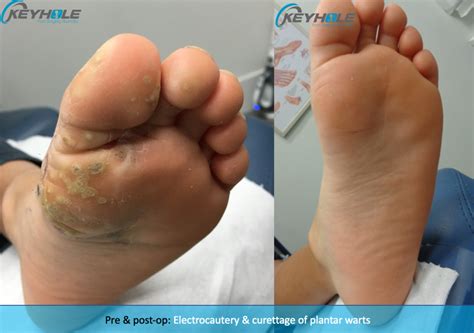 Plantar Warts - Perth Podiatric Surgery