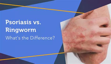 Psoriasis vs. Ringworm: What's the Difference? | MyPsoriasisTeam