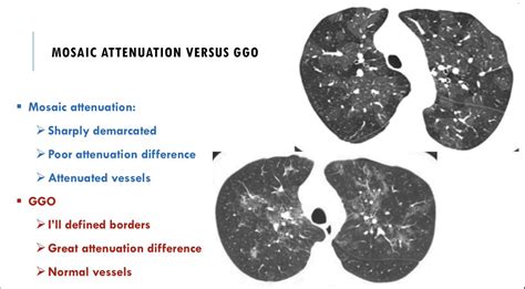 Discrimination between ground glass opacities and mosaic attenuation in crucial to avoid ...