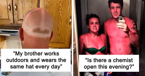 40+ World’s Worst Sunburn Fails