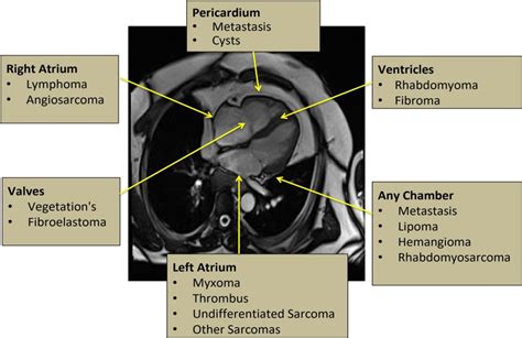 Frontiers | Tissue characterization of benign cardiac tumors by cardiac ...