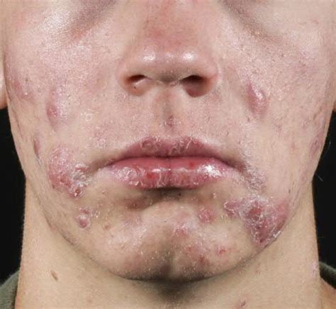 The Ultimate Solution to Cystic Acne - Orlando Dermatology Center