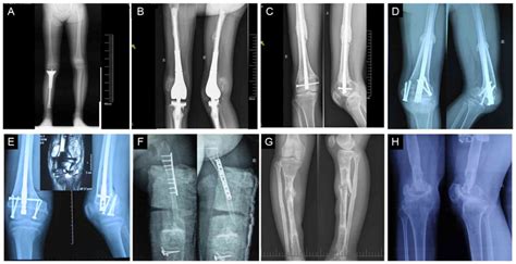 Osteosarcoma Knee Tumor