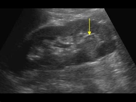 Image result for renal cell carcinoma ultrasound | Renal cell carcinoma ...