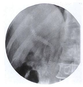 Intravenous Cholangiography - RadTechOnDuty