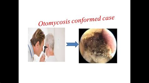 Otomycosis conformed case- KOH preparation-Positive - YouTube