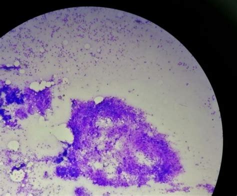 FNAC lymph node cytological study H&E stain: revealing chronic ...