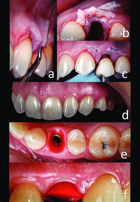 a) Preparing to allocate the connective tissue graft. b) Connective ...