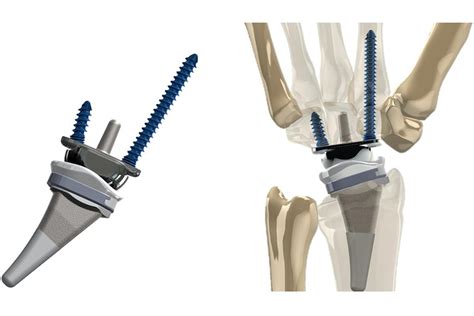 New wrist replacement is claimed to move better, last longer