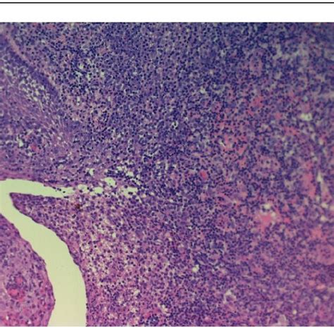 A, Subacute spongiotic dermatitis with focal parakeratosis and... | Download Scientific Diagram