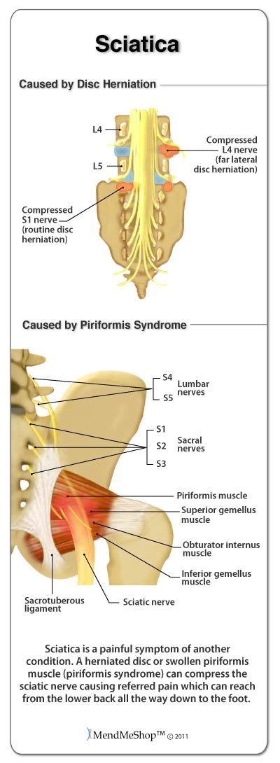 Treating Sciatica Pain