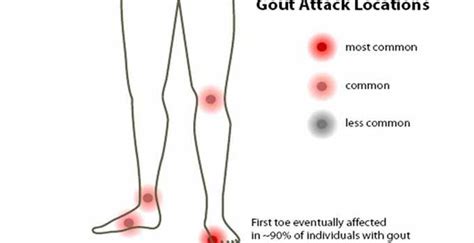 What vitamins cause uric acid – Health News