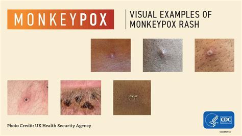 Monkeypox: How it spreads and how to avoid it