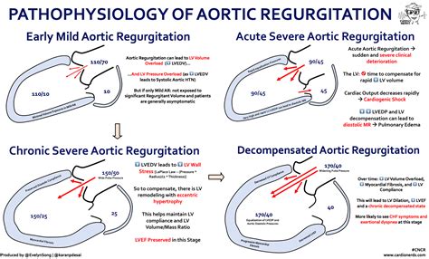 Syphilitic Aortitis with Severe Aortic Regurgitation - CardioNerds