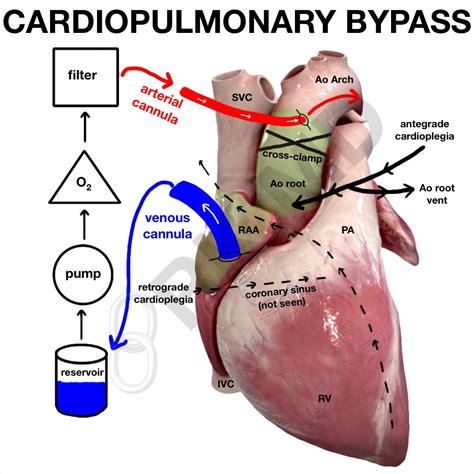 Cardiopulmonary Bypass Diagram