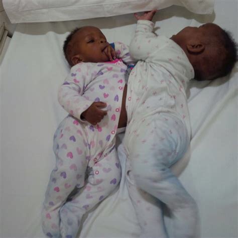 Nigerian Conjoined twins successfully separated - The Nation Newspaper