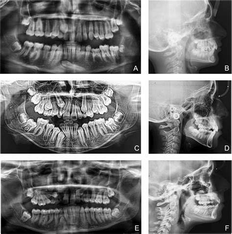 Local factors relating to mandibular canine impaction: A retrospective study - American Journal ...