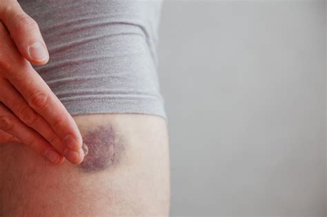 Hematoma Management | Restore Sports Medicine | Mountain Home, AR