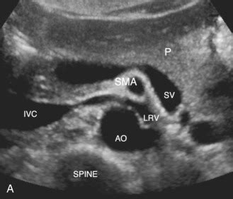 Inferior Mesenteric Artery Ultrasound