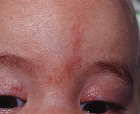 Birthmark causes, types of birthmarks and how to get rid of birthmarks