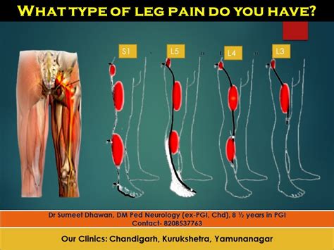 Back pain and leg pain- You may have a spine problem