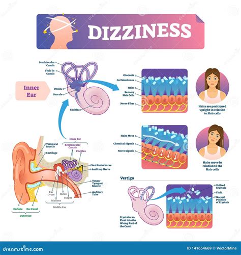 Dizziness Vector Illustration. Labeled Scheme With Inner Ear And ...