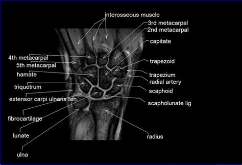 MRI wrist coronal anatomy | wrist tendon and ligaments anatomy | cross sectional anatomy | Wrist ...