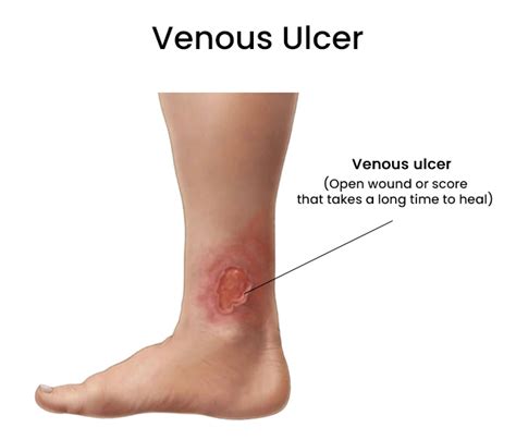 Venous Ulcers Treatment in Brooklyn, New York - Arterial Ulcers Specialist