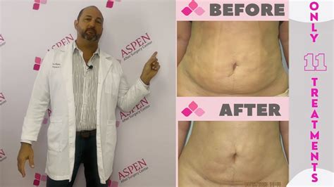 Liposuction Fibrosis Treatment- Soften and Smooth Lumps and Bumps - YouTube