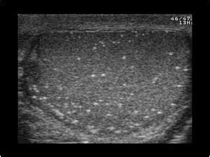 Urinary Tract and male reproductive system | 2.3 Scrotum : Case 2.3.13 Microlithiasis and ...