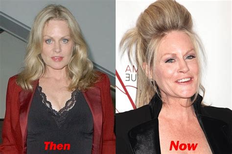 Beverly D'Angelo Plastic Surgery Before And After Face Photos