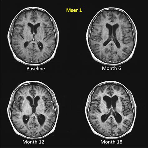 Multiple Sclerosis Research: Brain atrophy: the ultimate outcome in MS