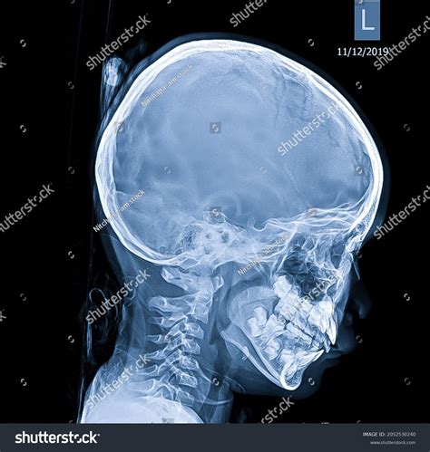 11 Left Side Skull Fractures Images, Stock Photos & Vectors | Shutterstock