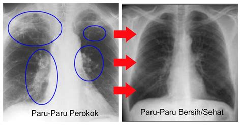 Paru - Paru Perokok Bisa Bersih Lagi Hanya Dengan Rajin Konsumsi 9 Makanan dan Minuman Berikut ...