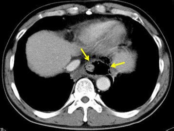 A chest CT scan revealed pneumomediastinum | Download Scientific Diagram