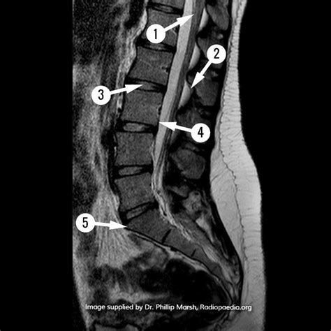 Mri Images Spine