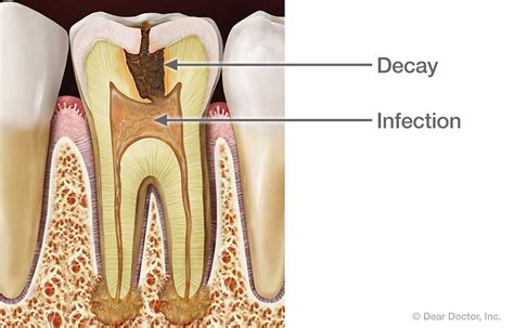 Root Canal Treatment | Glen Ellyn