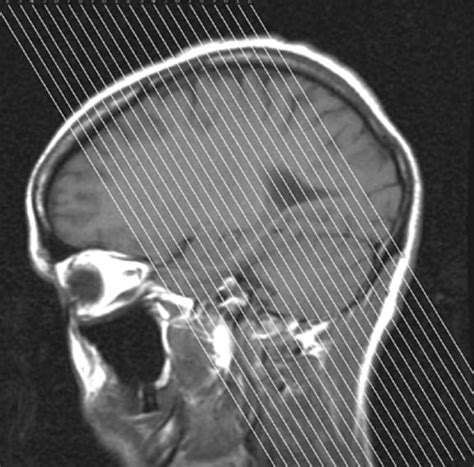 Technology and Techniques in Radiology: Hippocampus MRI