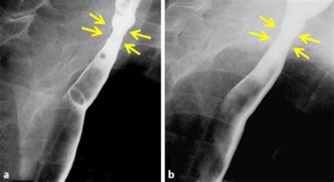 Upper esophageal web seen on barium-swallow esophagogra | Open-i