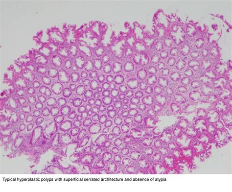 Pathology Outlines - Hyperplastic polyp