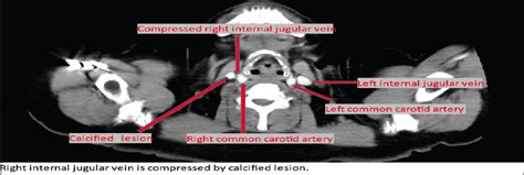 Obstacles to ultrasound-guided internal jugular vein central... : Saudi Journal of Anaesthesia