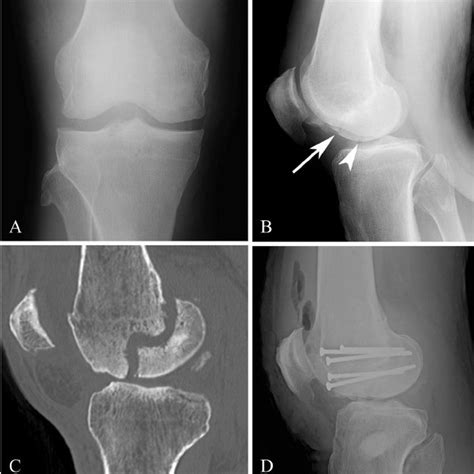 A 44-year-old male with a nonunited Hoffa fracture of the lateral ...