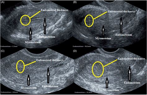 Endometrium Measurement Ultrasound