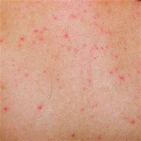 Bartonella Infections; Carrion's Disease; Oroya Fever; Verruga Peruana; Bartonellosis ...